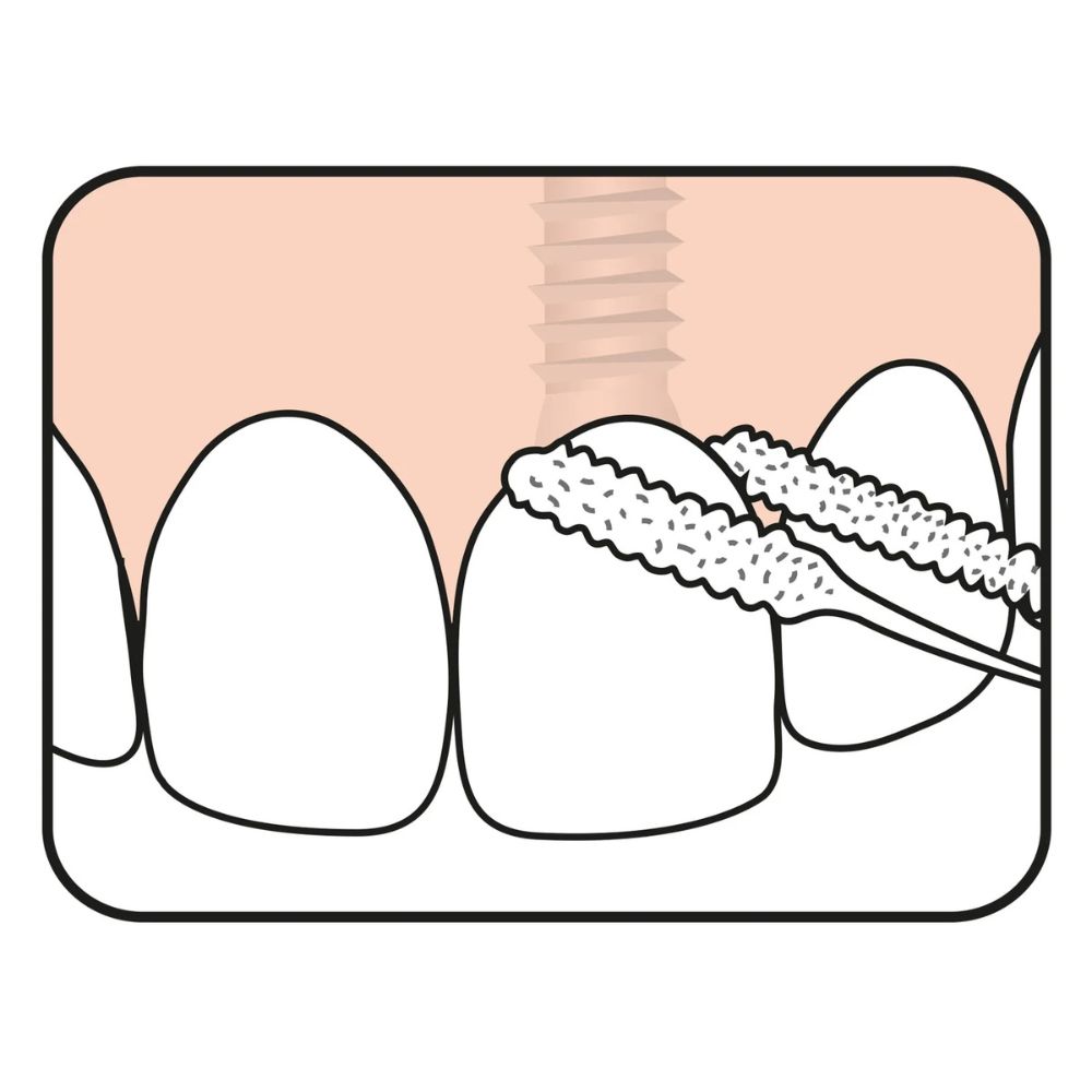 TePe Bridge & Implant Dental Floss Pack Of 30