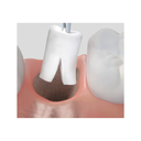 Resorba Parasorb Absorbable Collagen Cones Pack Of 10